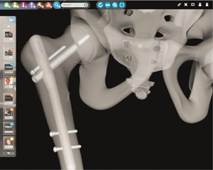 Running smoothly: Fast and effective joint replacements Running smoothly: Fast and effective joint replacements