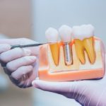 Can Seniors Get Dental Implants