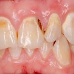 Can You Reverse Tooth Decay