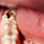 Can You Reverse Tooth Decay1