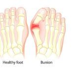 How Bunions Affect Your Overall Health1