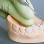 What To Know Before Getting A Dental Bridge