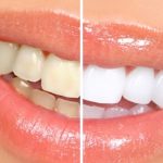 Whitening Treatment1