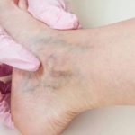 signs-of-vein-disease