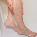 varicose-veins-home-treatment