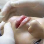 Botox1