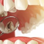 Cavities