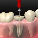 root-canal-treatment