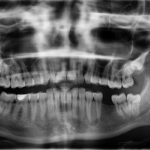 Dental X-Rays