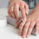 Generalized Pustular Psoriasis
