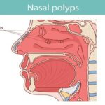 Nasal Polyps Removed1