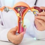 Ovarian Cyst