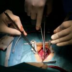 Heart-Transplantation-Eligibility-and-Evaluation