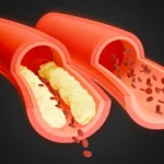 Peripheral-Arterial-Disease-warning-signs-and-treatments