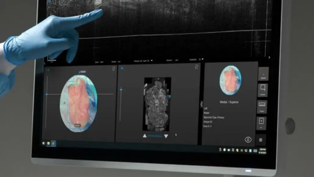 Breast Cancer Surgery Using AI