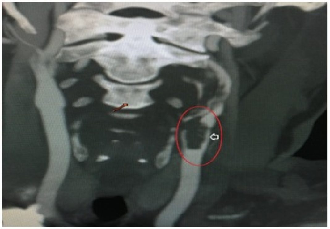 Carotid Endarterectomy - A Stroke risk reduction Surgery
