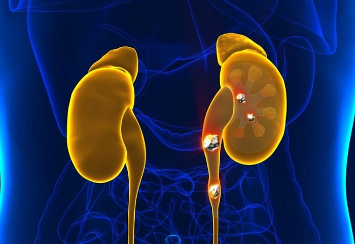 Be Ready to Treat Kidney Stones in Obese Patients
