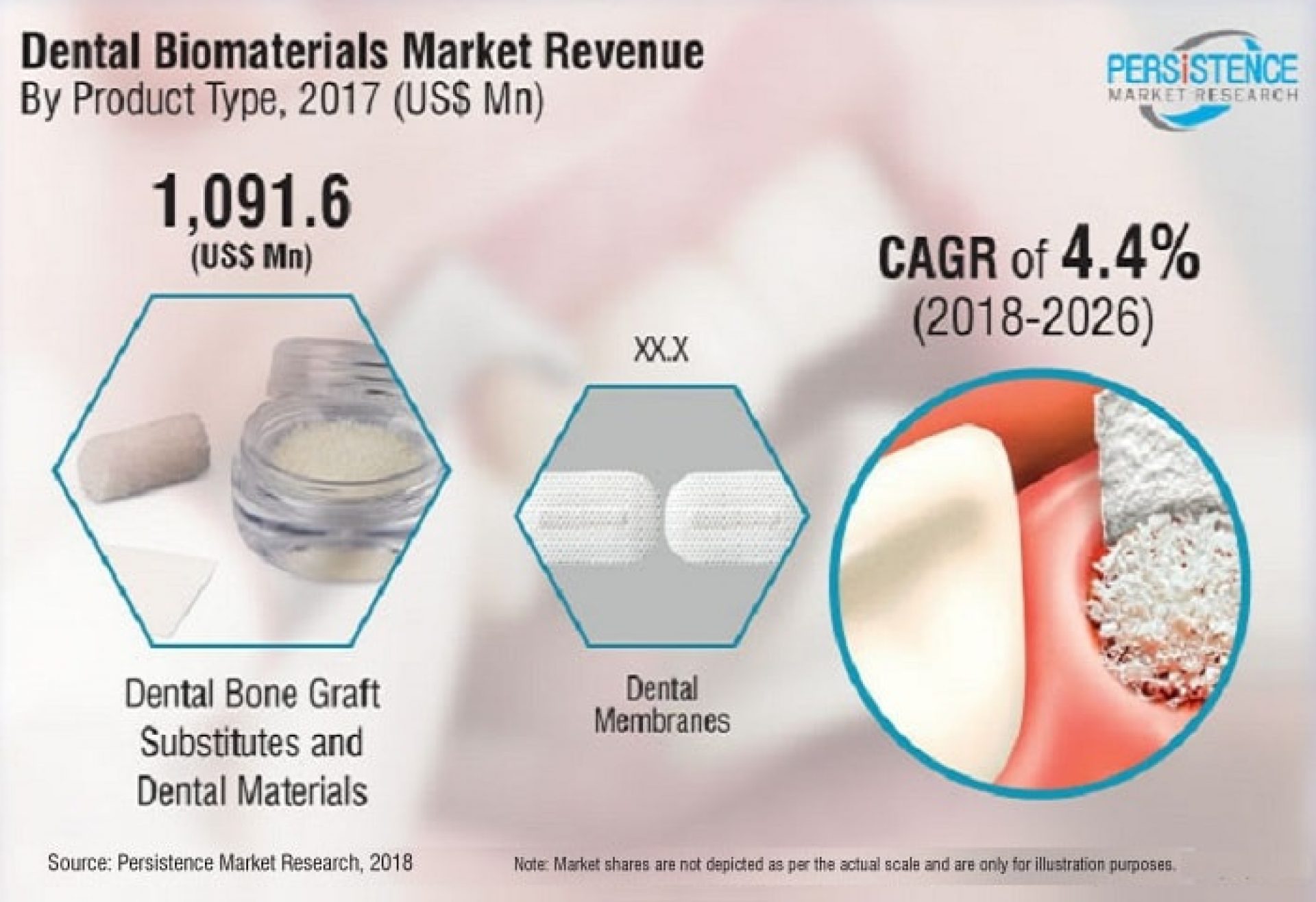 global dental biomaterials market expected to account over 1880 Mn US Dollars