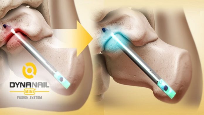 DynaNail MiniTM Fusion System DynaNail MiniTM Fusion System
