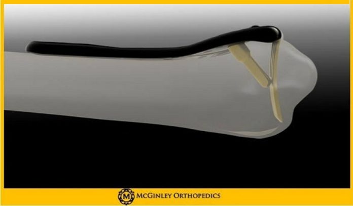 McGinley OrthopedicsLaunches New Plate for Distal Radius Fractures: Lever Action Plate System