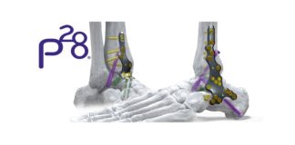Phantom ActivCore Nail System Receives FDA Clearance - Continuous Compression Hindfoot Nail System