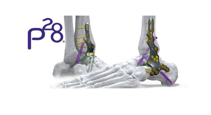 Phantom ActivCore Nail System Receives FDA Clearance - Continuous Compression Hindfoot Nail System