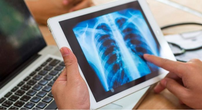eNose technology helps to diagnose interstitial lung disease