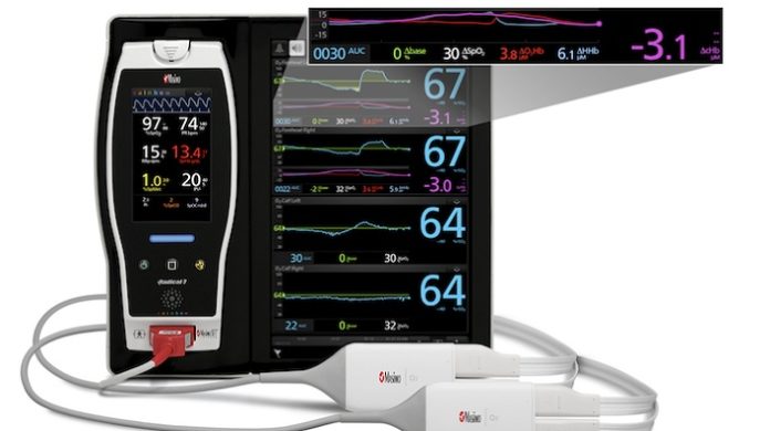 Masimo scores extended FDA clearance for cerebral hemoglobin monitoring