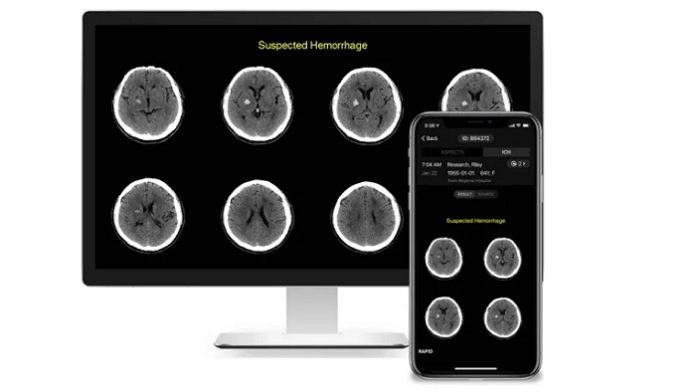 RapidAI Receives $25 M To Expand AI-Enhanced Cerebrovascular Imaging Around The World