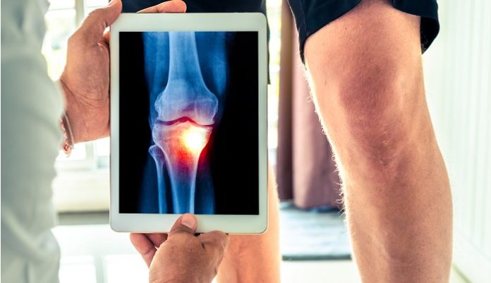 8 Signs You Should Get Knee Surgery 