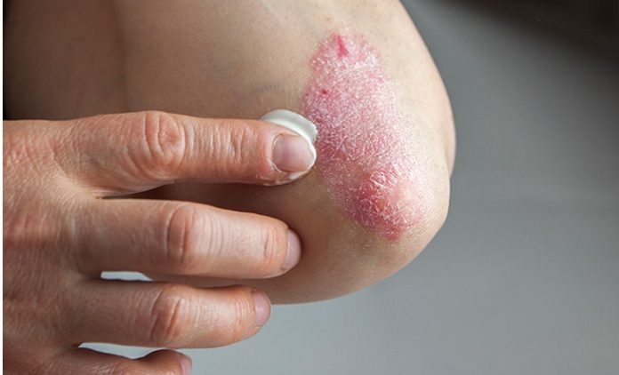 Eczema & Psoriasis: - Two Varied Branches of The Same Tree