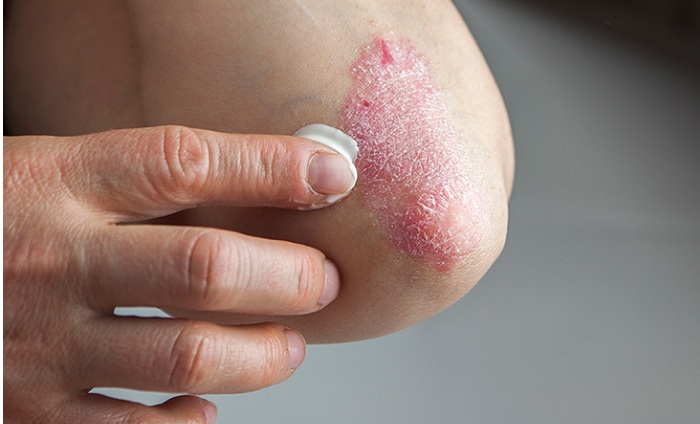 Eczema & Psoriasis: - Two Varied Branches of The Same Tree
