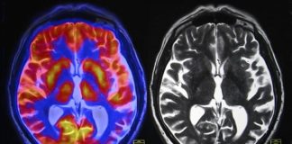 University of Oregon partnering with mental health specialist PeaceHealth on schizophrenia imaging project