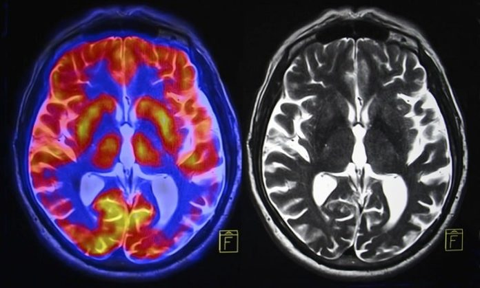 University of Oregon partnering with mental health specialist PeaceHealth on schizophrenia imaging project