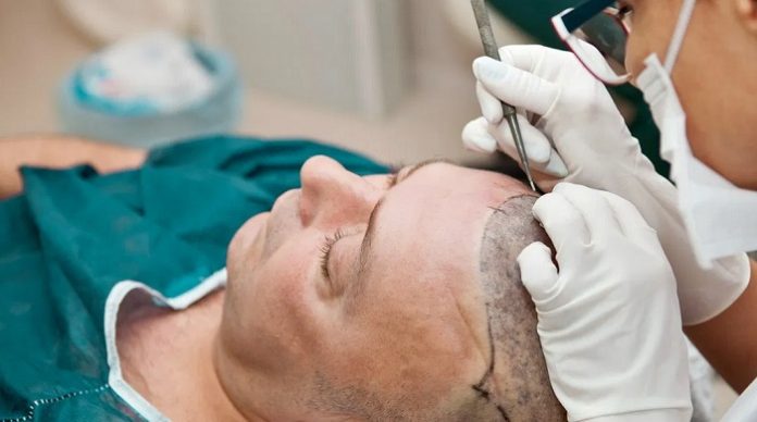 Hair Transplant For People With Curly Hair