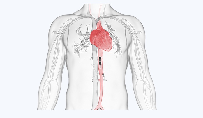 Puzzle Medical Devices Inc. Receives U.S. FDA Breakthrough Device Designation for Its Revolutionary Minimally Invasive Transcatheter Heart Pump