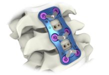 Aurora Spine Receives FDA Clearance for Its Proprietary APOLLO Anterior Cervical Plate