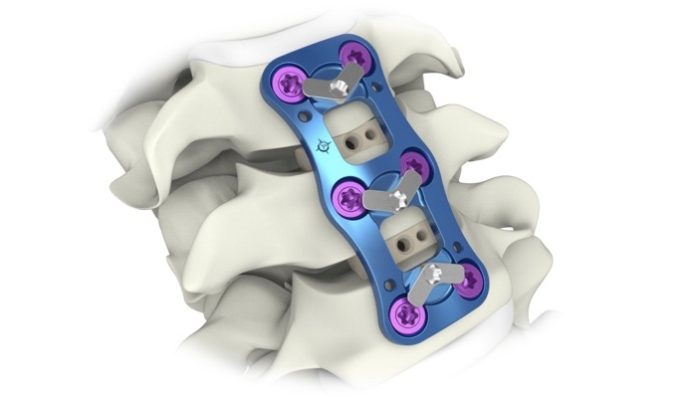 Aurora Spine Receives FDA Clearance for Its Proprietary APOLLO Anterior Cervical Plate