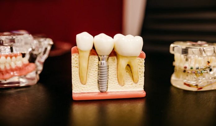 Everything You Need To Know About Root Canal