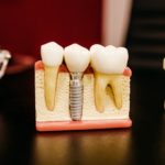 Everything You Need To Know About Root Canal