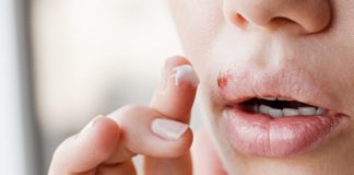 Herpes: Causes, Symptoms, And Treatment