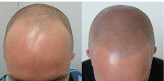 Scalp Micropigmentation: Illusion of Hair