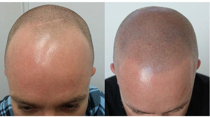 Scalp Micropigmentation: Illusion of Hair