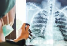 Scores Detected With Cancer Early Due To NHS Lung Screenings