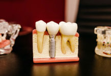 The Main Benefits Of Having Dental Insurance