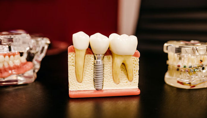 The Main Benefits Of Having Dental Insurance