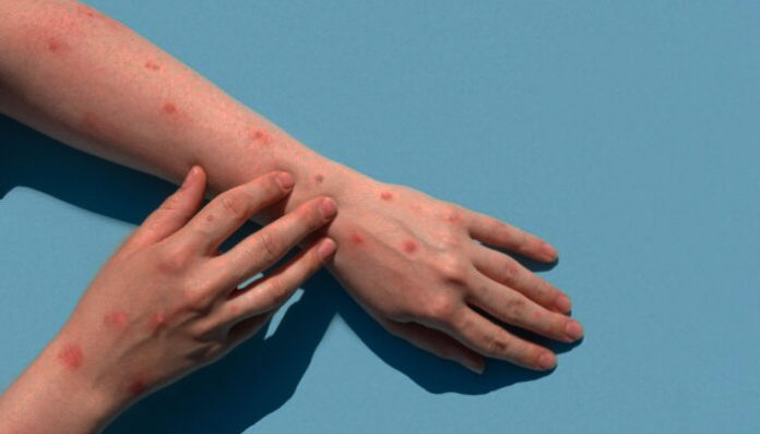 Global Health Rules Crisis Group To Study Monkeypox Spread