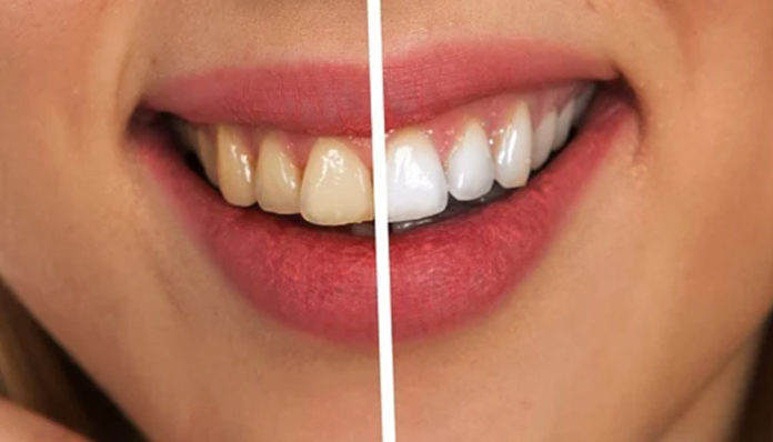 Latest Dentistry Trends: 6 Ways To Achieve A Shiny Smile