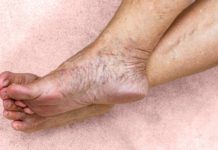 Chronic Venous Insufficiency: What Are the Signs and Treatment