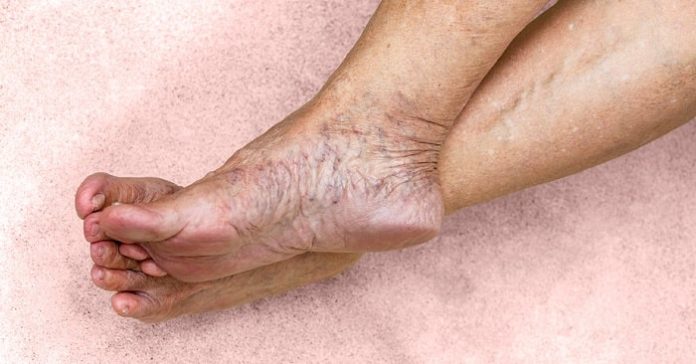 Chronic Venous Insufficiency: What Are the Signs and Treatment